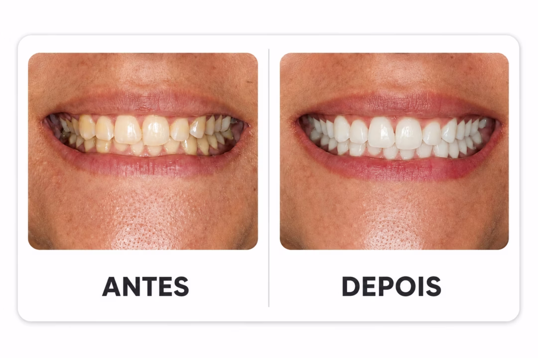 01_antes_depois_sorriso_frontal
