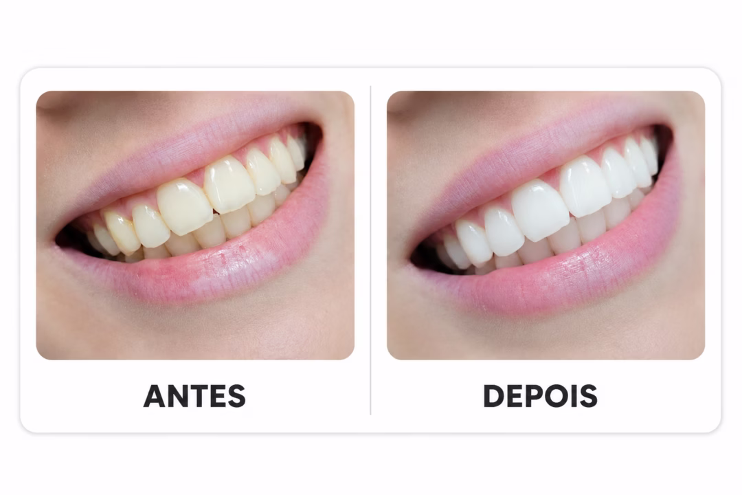 04_antes_depois_clareamento