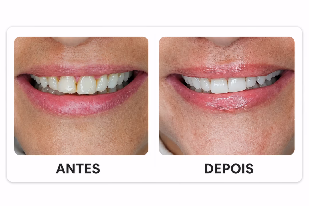 05_antes_depois_lentes_dentais